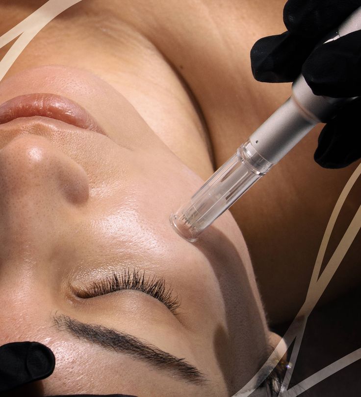 Microneedling - Rajeunissement et Réparation de la Peau